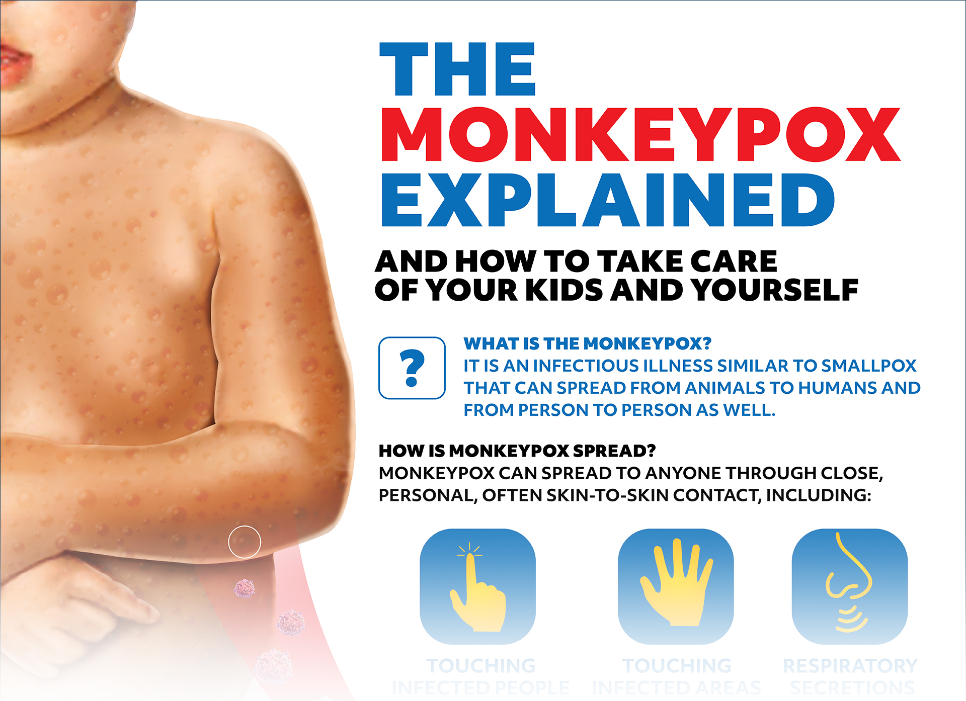 Monkeypox Infographic